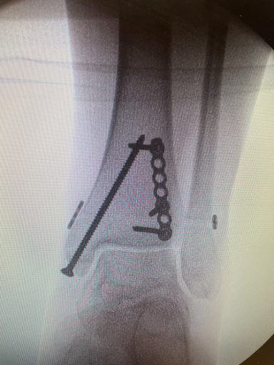 Ankle fracture X-ray