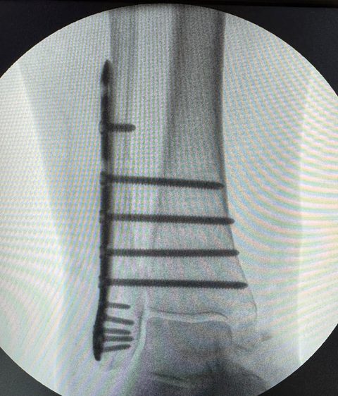 Ankle fracture in diabetes X-ray