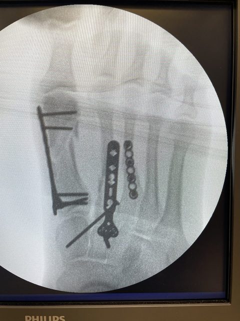 Metatarsal fracture X-ray