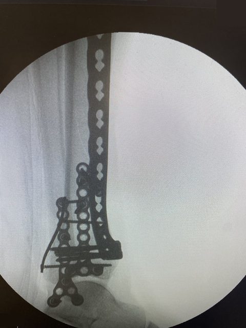 Pilon fracture X-ray