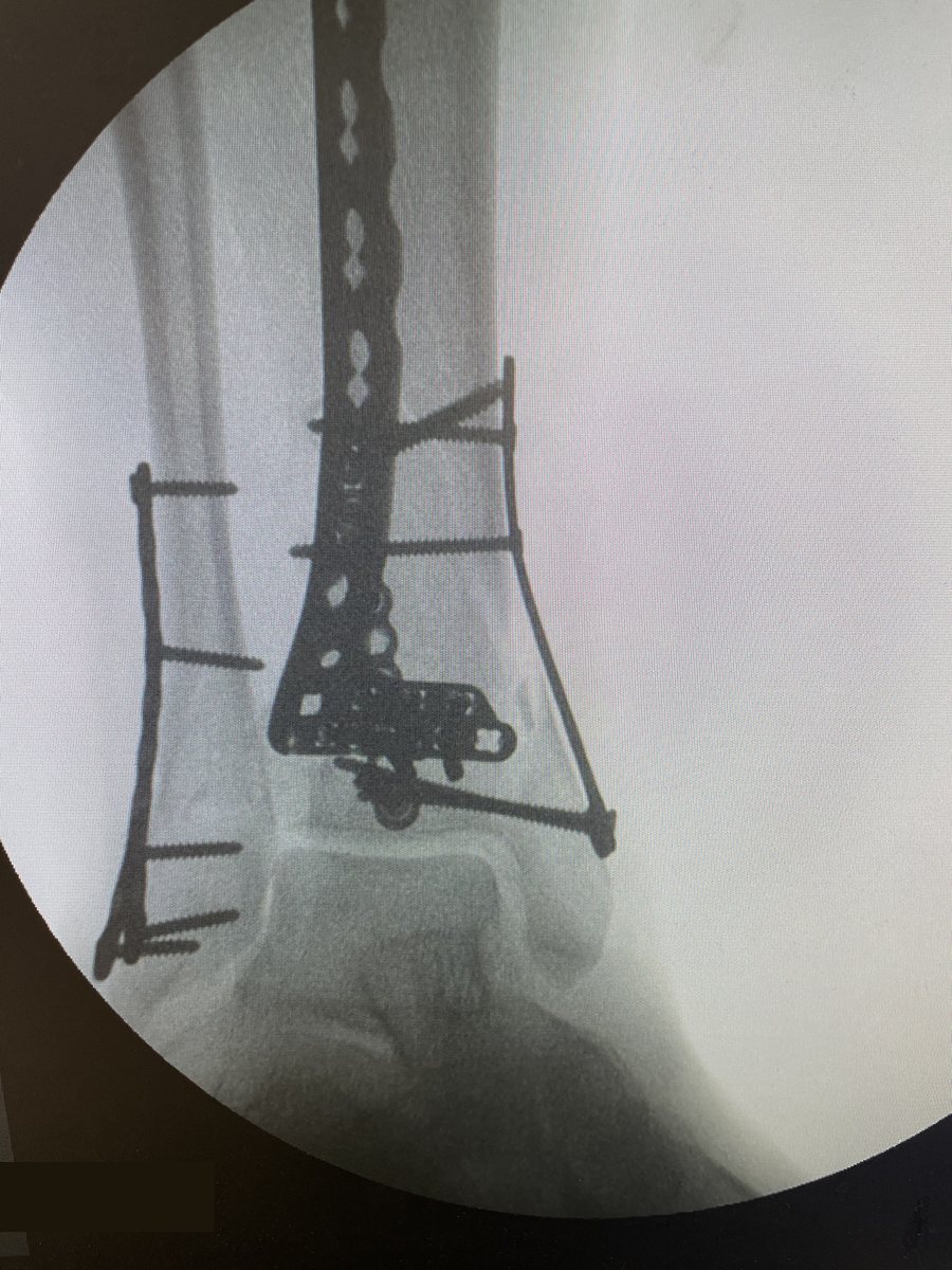 Pilon fracture fixed with plates